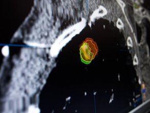 iPlan RTソフトウェアで自動描出した肺がんの輪郭
