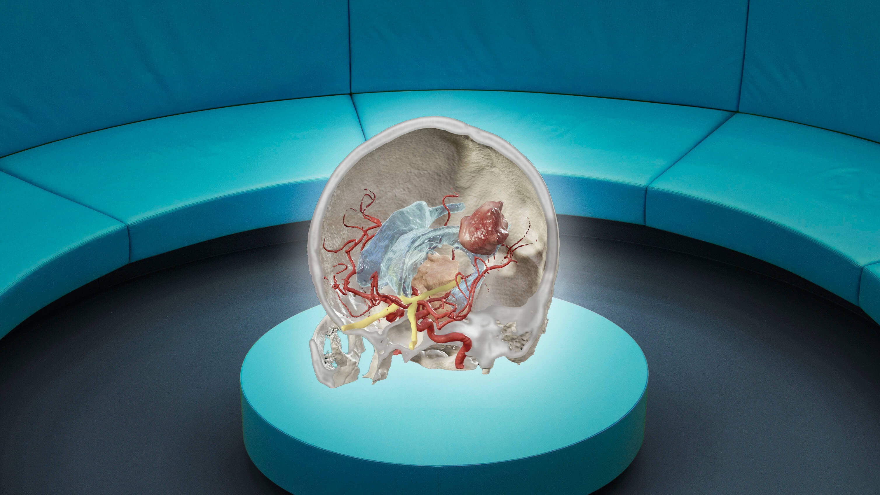 血管や腫瘍等の解剖学的構造物を示す、頭蓋内の拡張現実表示