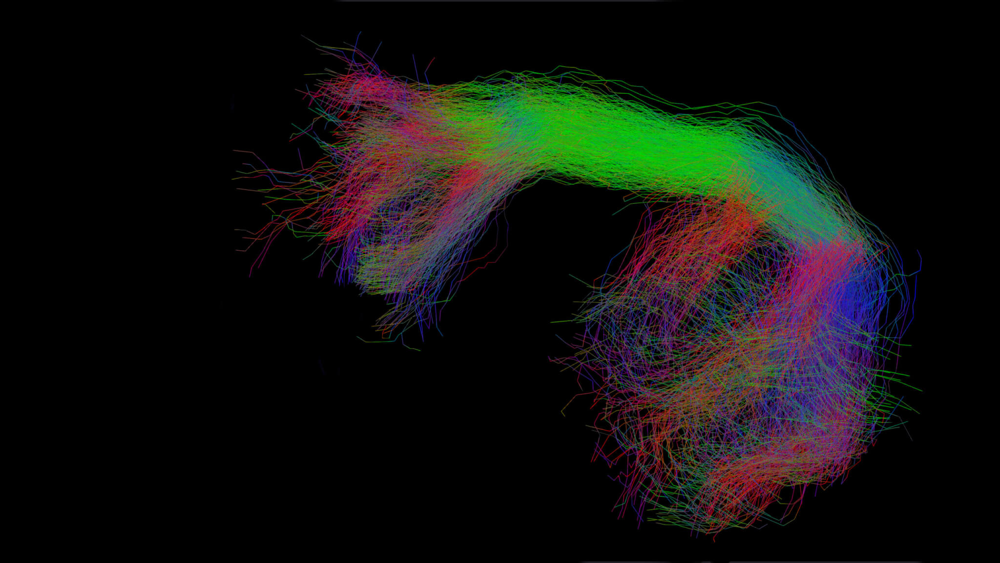Visualization of tracking templates for important white matter tracts like IFOF and CST in a clinical practice setting