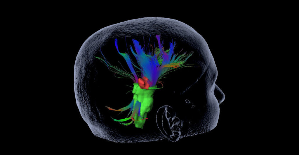 3D brain visualization for surgical planning and analytics.