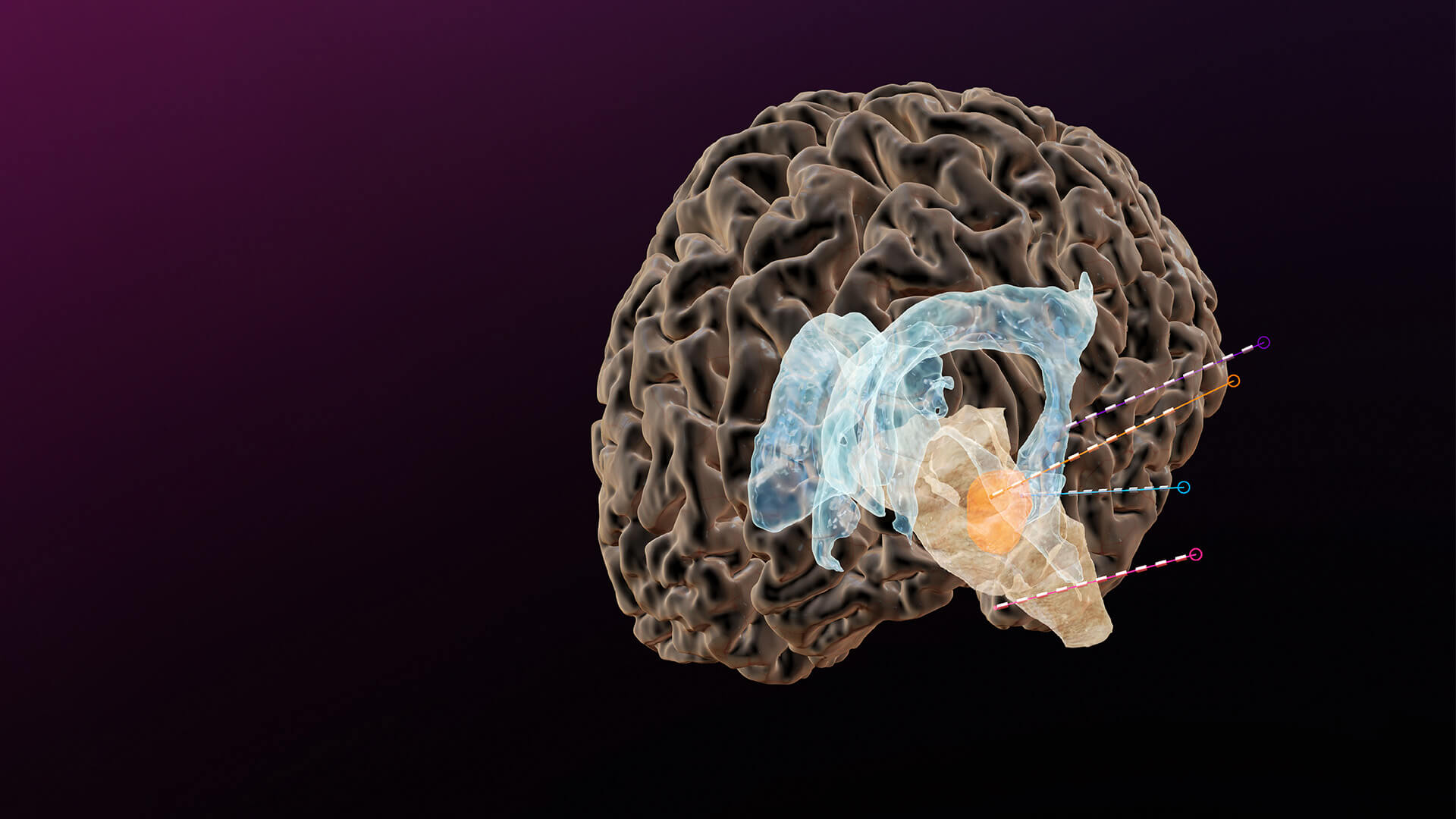 Visual showcasing Brainlab's functional neurosurgery portfolio