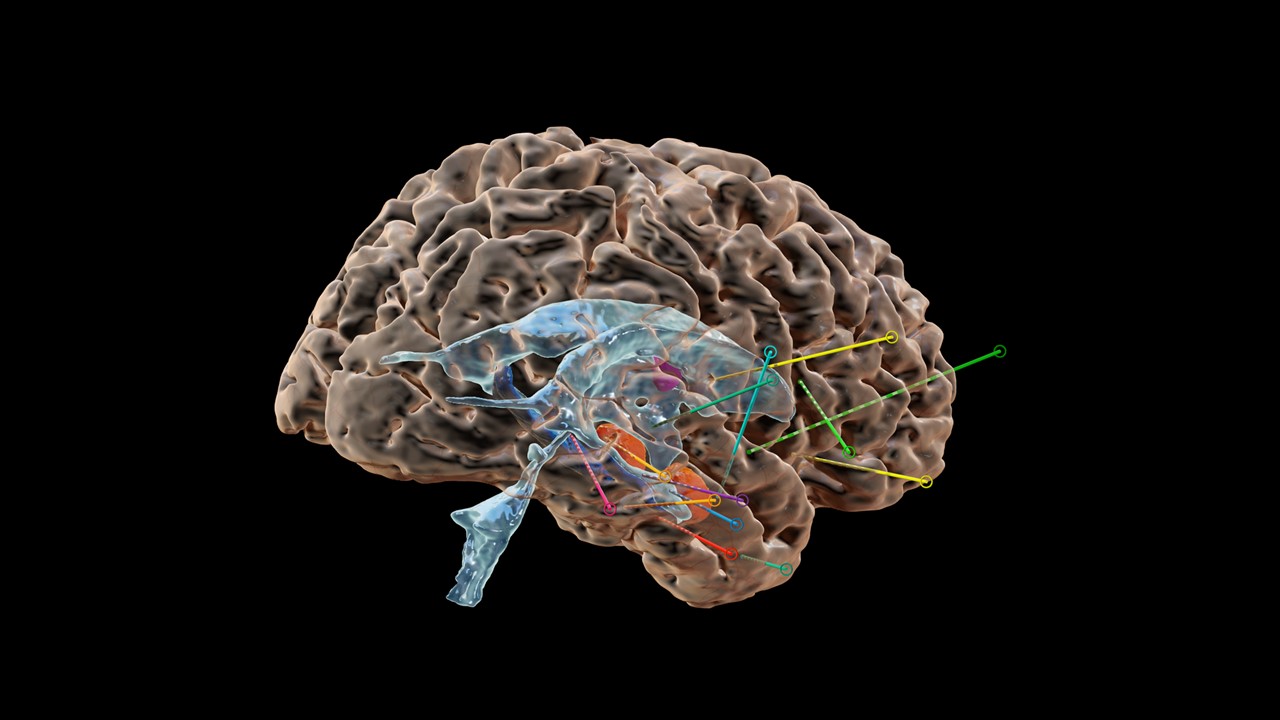 epilepsywebinar2.jpg