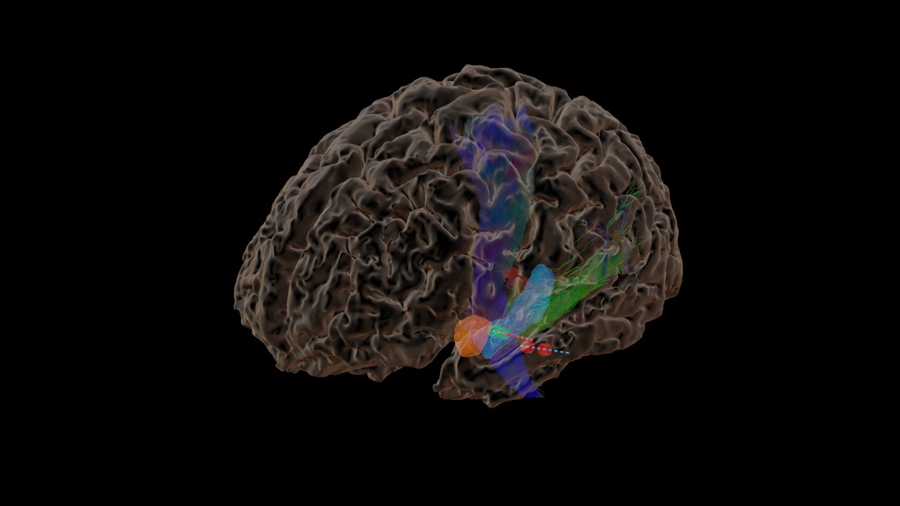 hero_visual_epilepsywebinar3.jpg