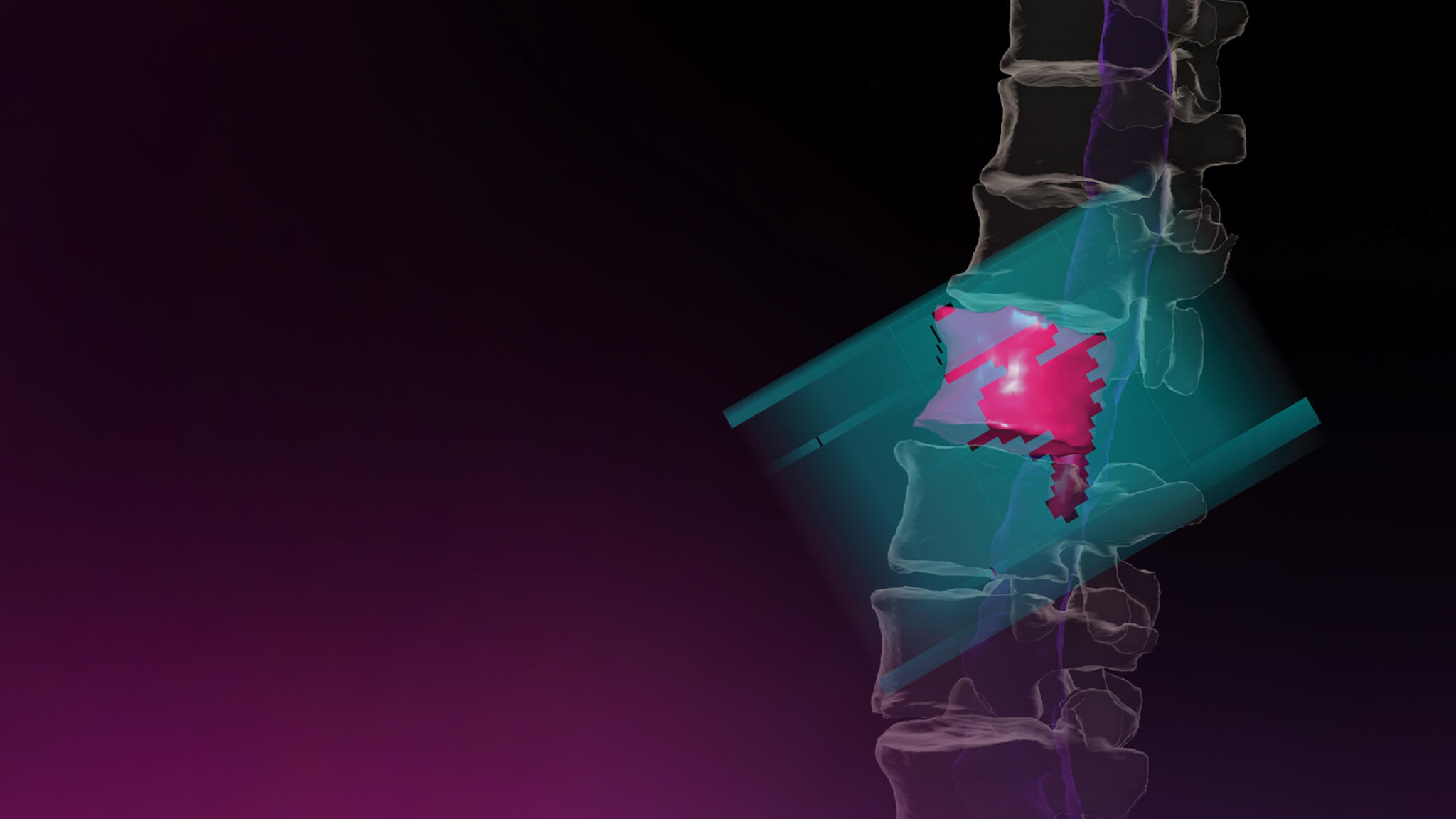 Hero visual for Spine metastases workflow