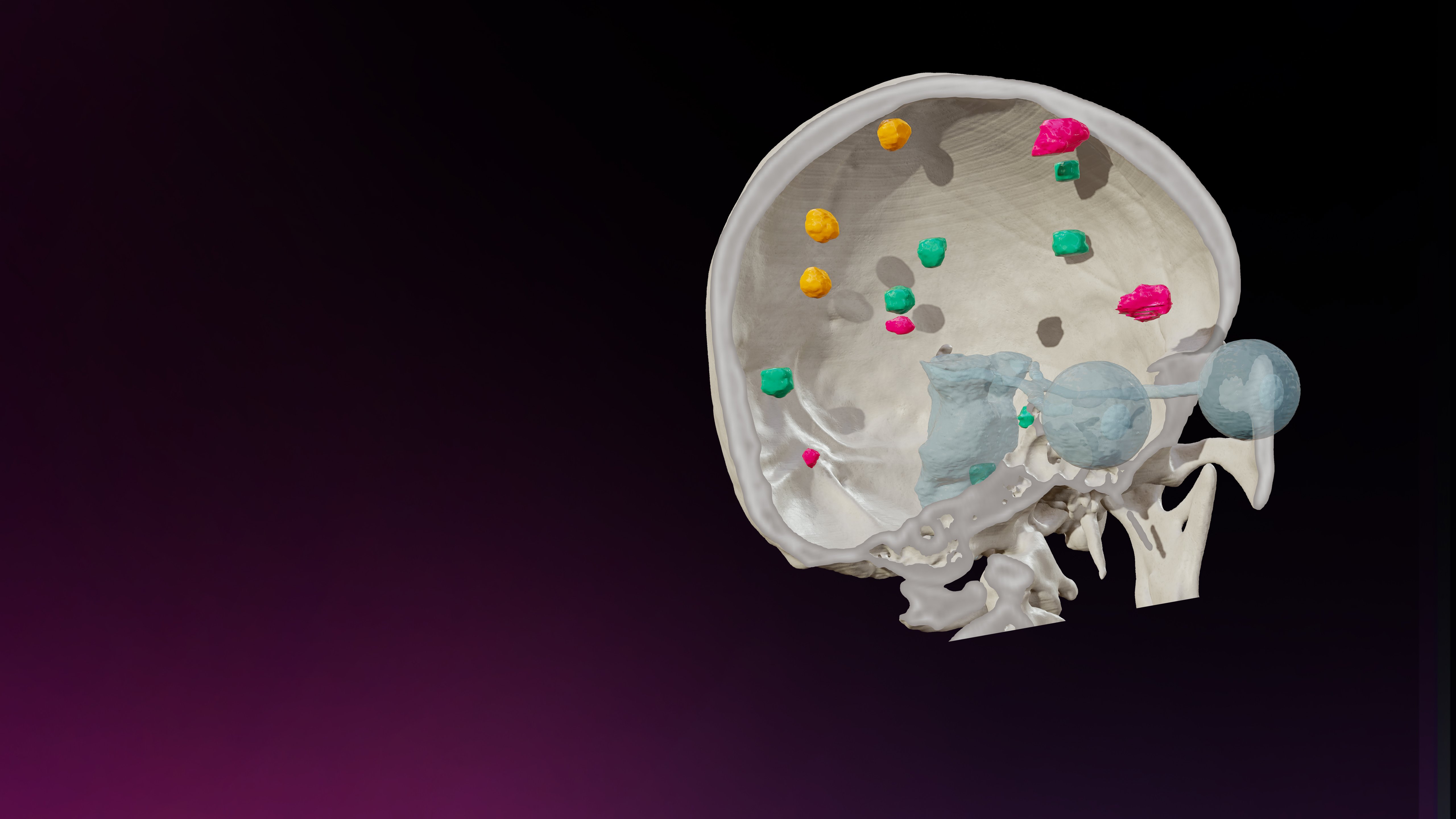 Elements Solutions for Multiple Brain Mets SRS | Brainlab