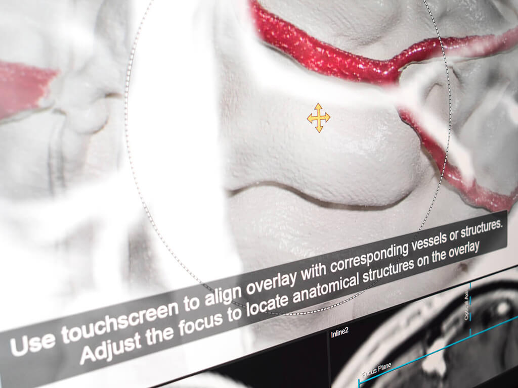 Visualizing anatomy shift by comparing vessels on the cortex with their corresponding MIP