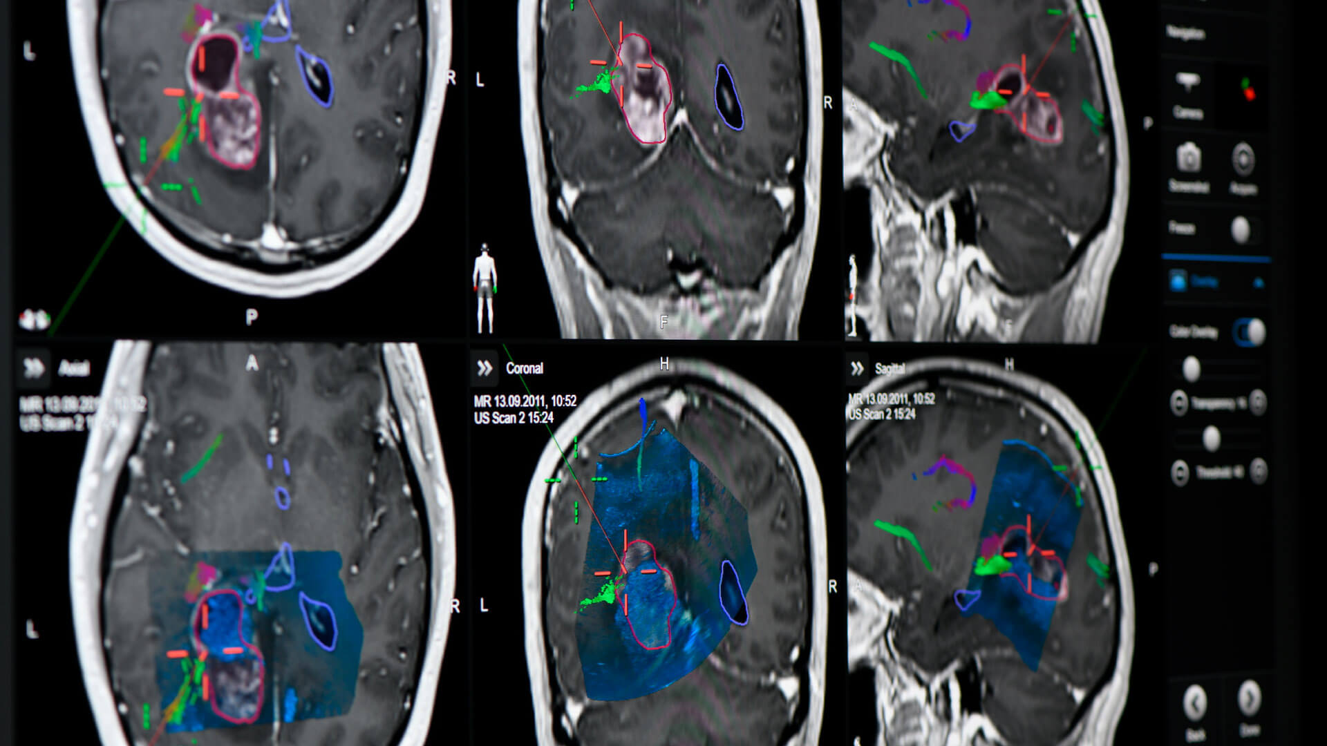 Screenshot of the Ultrasound Navigation: real-time intraoperative imaging for cranial image guidance