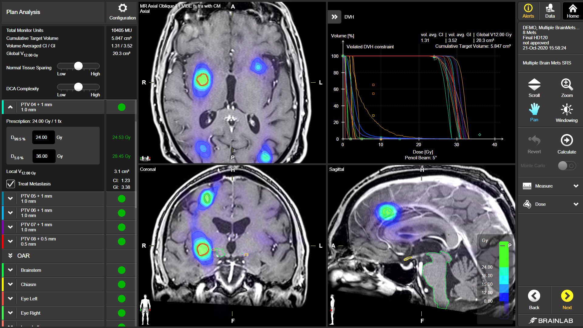 rt_sc_multiple-brain-mets-srs_1_oct2020.png
