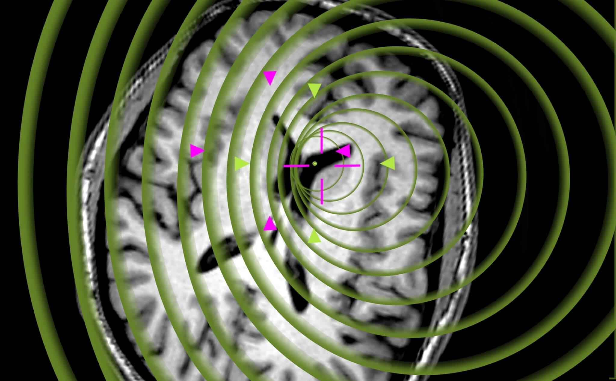 Header Background: Brainlab Electromagnetic (EM) Navigation System for Cranial Procedures