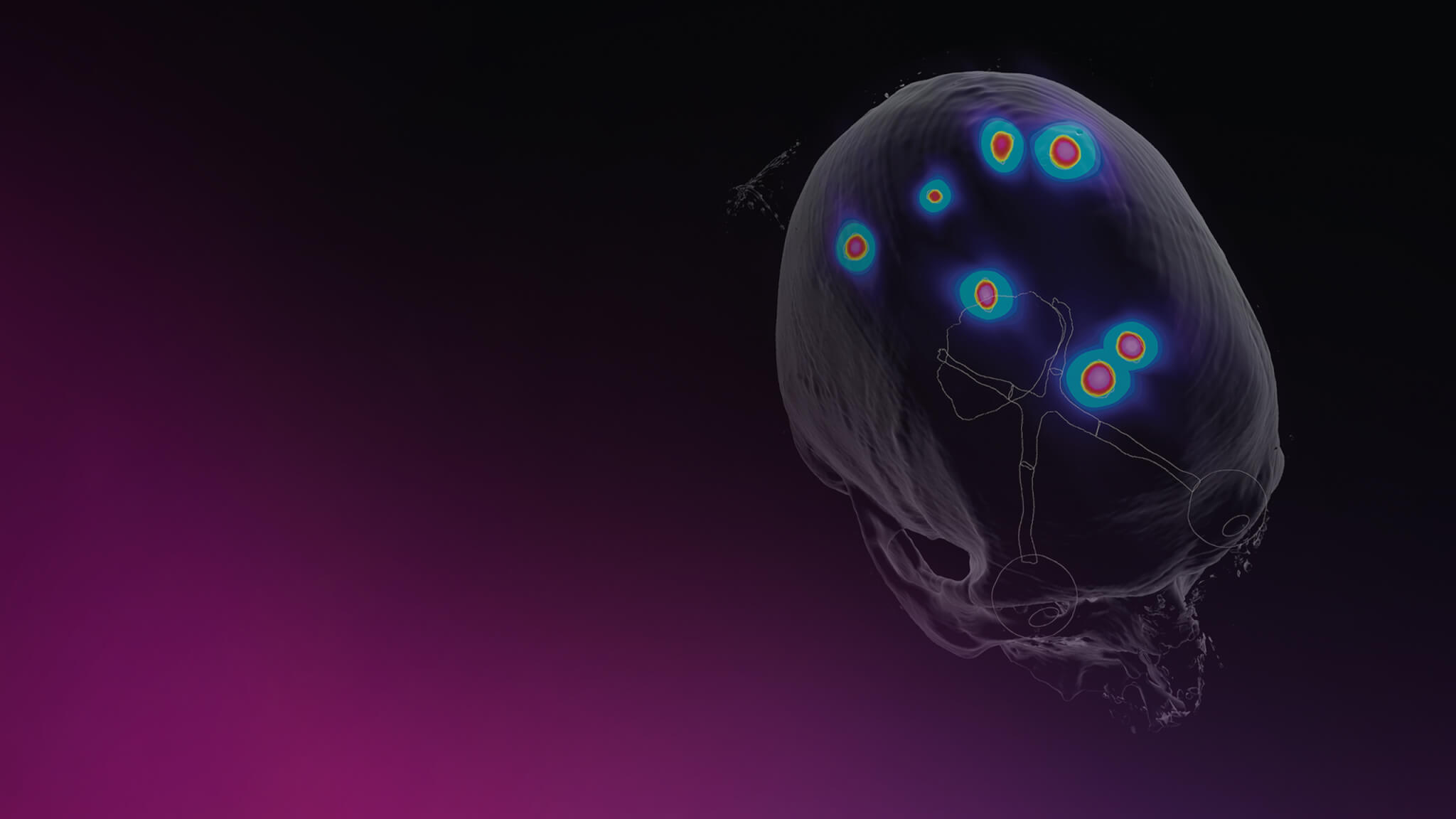 Key Visual: Elements Multiple Brain Metastases Workflow