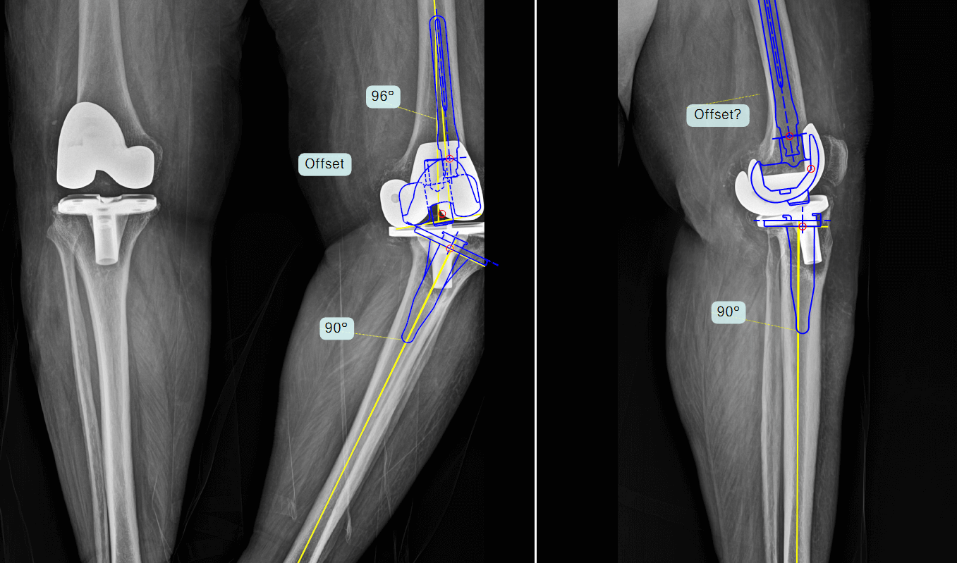 visual-v2-traumacad-knee-story.png