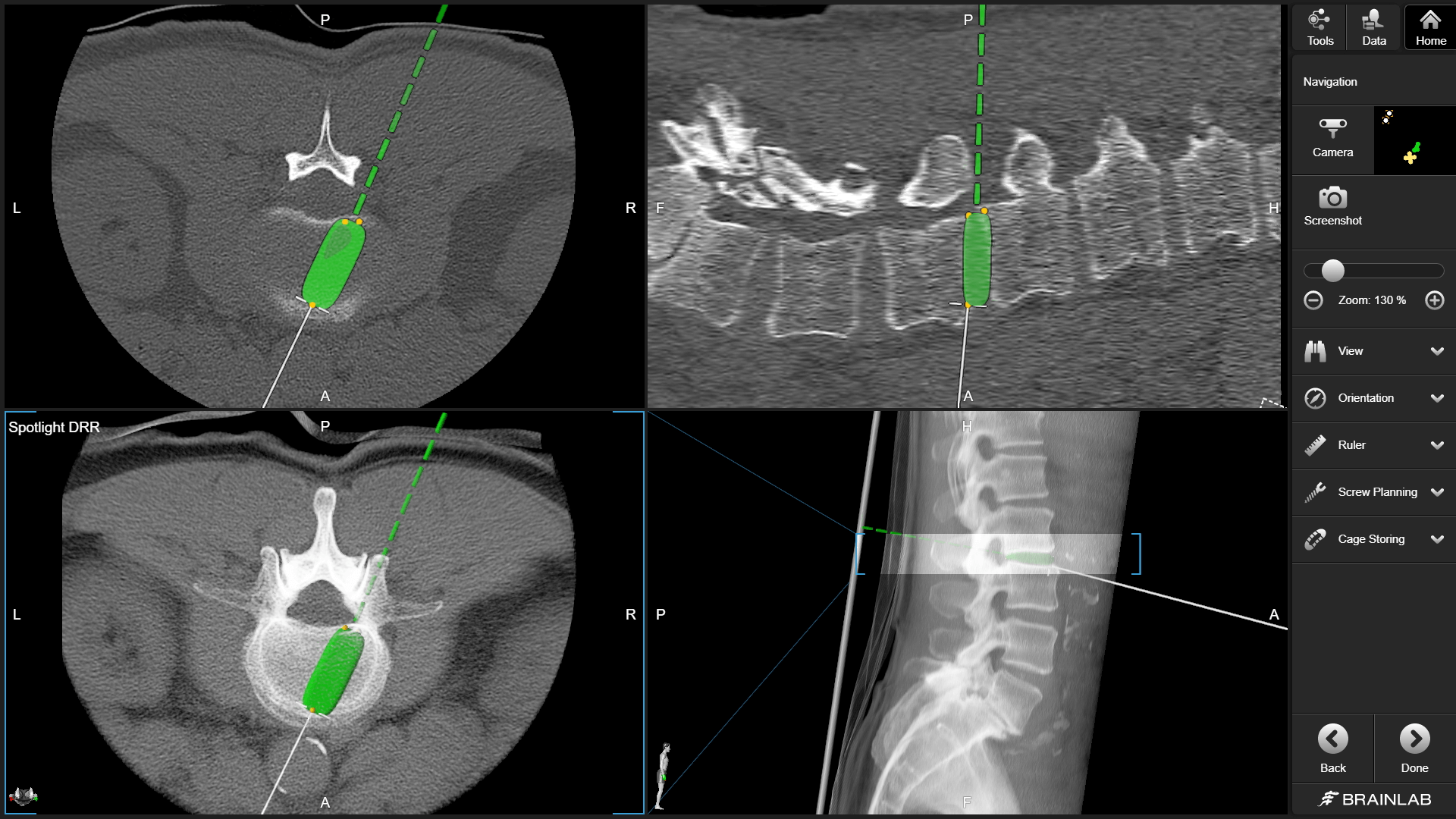 Screenshot of Brainlab Spine Navigation Software displaying support for navigated cage placement to achieve desired positioning