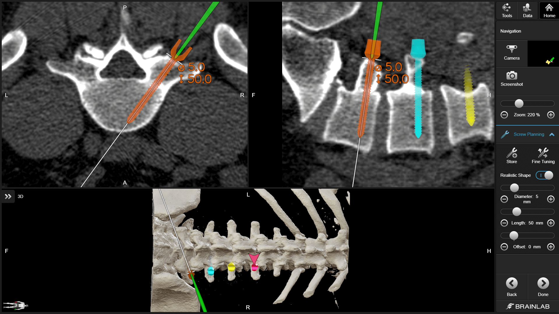 Screenshot of the Brainlab Spine Navigation Software focusing on navigation