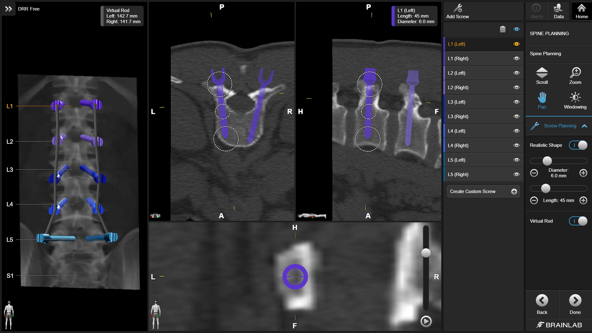 Screenshot: Elements Spine Planning defining optimal screw trajectories across multiple image modalities