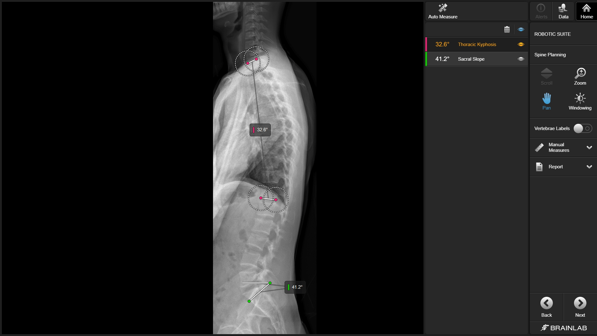 Screenshot of the automatic measurements function within Elements for Spine Planning