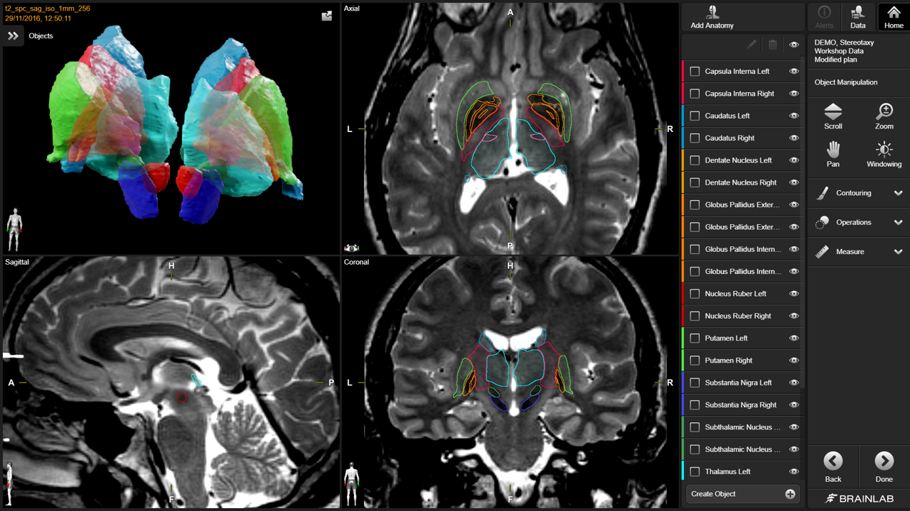 basal-ganglia-segmentation.png