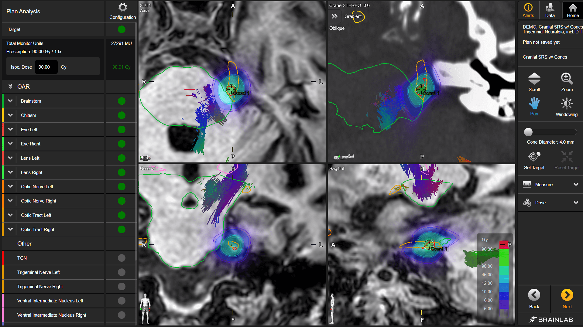Screenshot of Elements Cranial SRS: display of fiber tracts in planning