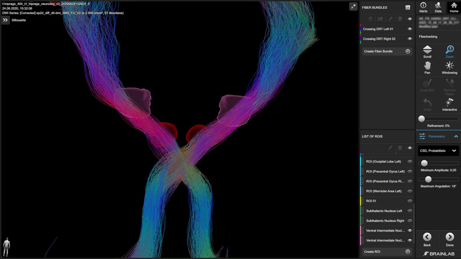 fibertracking-and-basal-ganglia.png