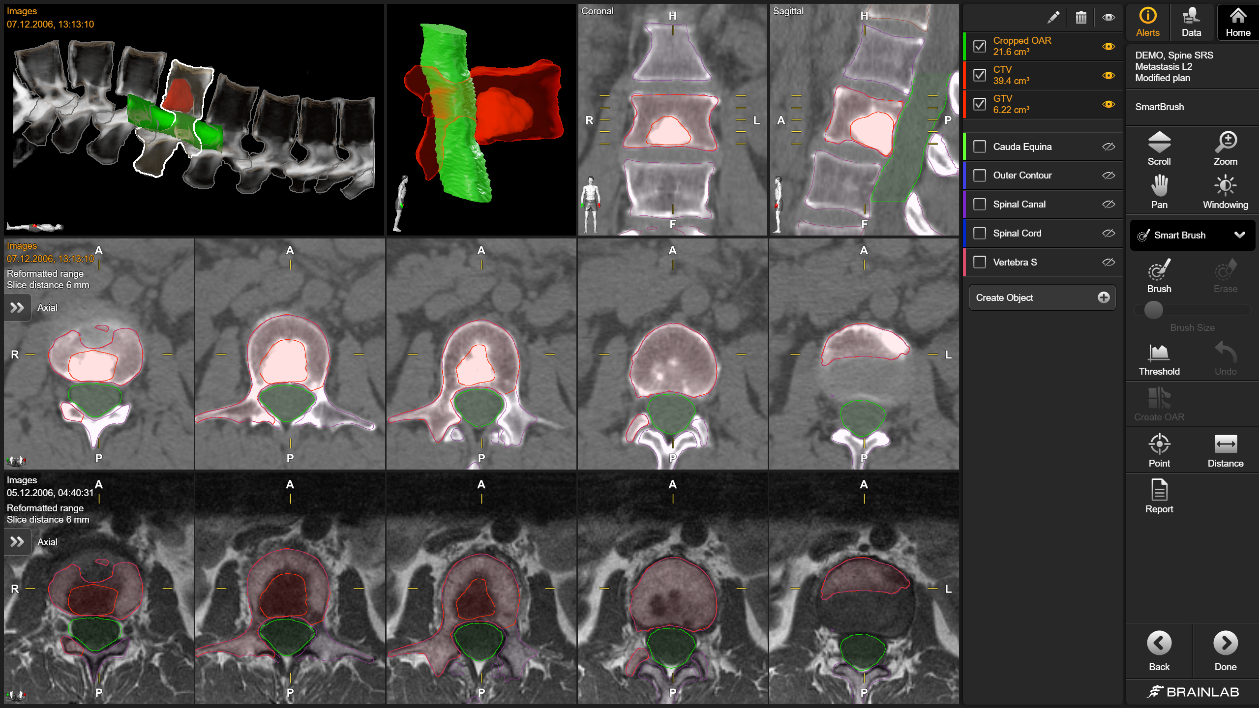 Screenshot: Elements SmartBrush Spine SRS - Delineating spine metastases