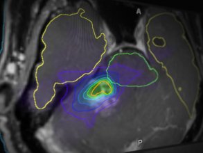 Software optimized surgical plan to account for follow up radiosurgery