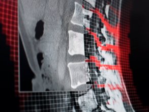 通过匹配 MR 和 CT 或 CT 和 CT 影像的解剖映射所构建的形变联合配准，可补偿脊柱的弯曲