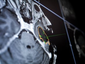 Logiciel de neuronavigation affichant des données d’IRM peropératoire