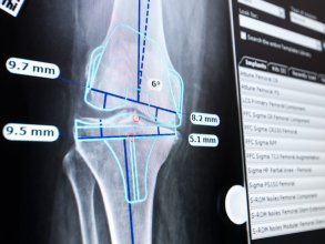 TraumaCad Digital Templatingを用いた膝関節全置換術のプランニング