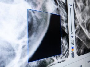 „Spy Glass“-Ansicht zur Bewertung der Fusion von Knochenstrukturen für die intra-kraniale Radiochirurgie