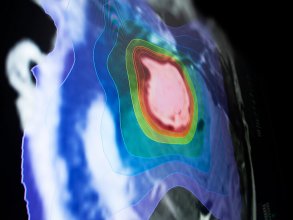 O pacote de software de radiocirurgia estereotática de crânio (SRS) da Brainlab expande as possibilidades de planejamento de tratamentos radiocirúrgicos