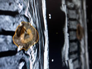 脊椎手術のプランニングオプションとして､ナビゲーションガイド下での腫瘍切除においてSmartbrushによる輪郭描画機能により腫瘍のアウトライン作成が可能です