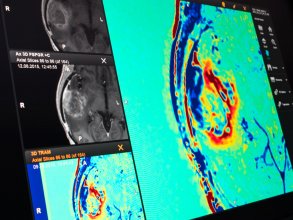 従来の3D造影MRI画像を比較解析することにより、腫瘍に関する追加情報の取得が可能