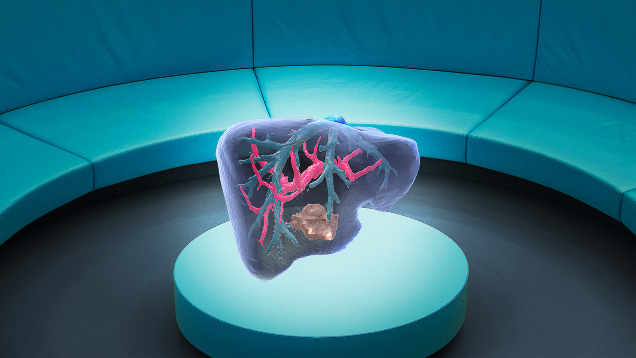 一个出现肿瘤的肝脏的混合现实视图