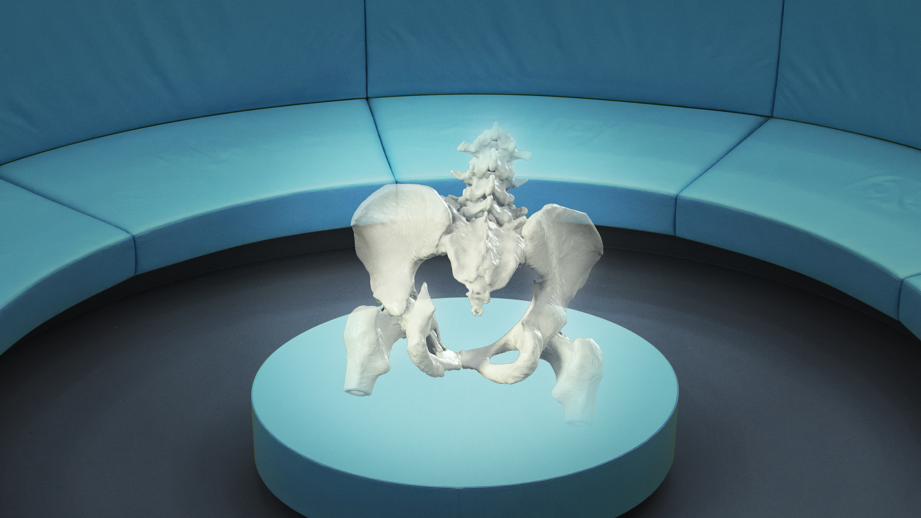 A mixed reality view of the bones of a human pelvis showing a fracture