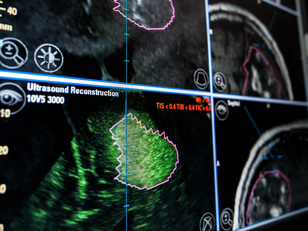 超音波画像とのオーバーレイが可能な脳神経外科用ナビゲーションソフトウェア