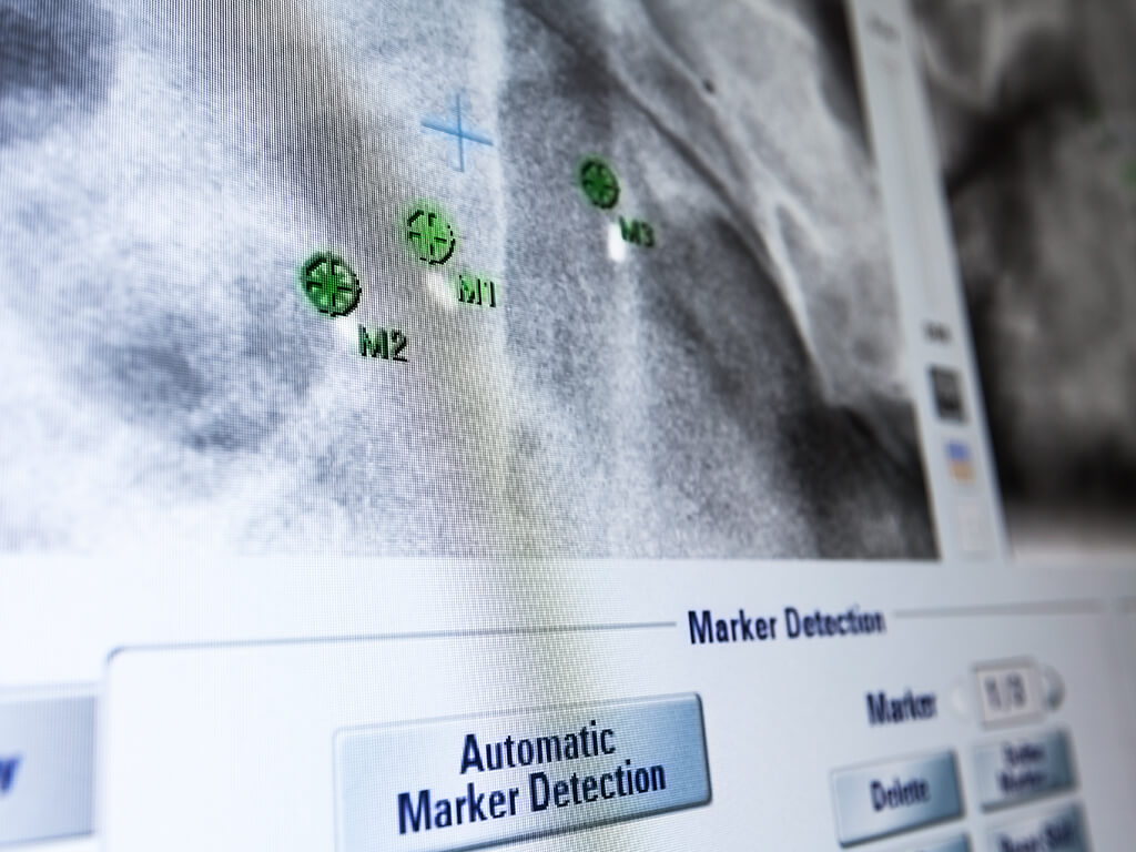 Image guided radiotherapy system detecting implanted markers to help locate the tumor or target