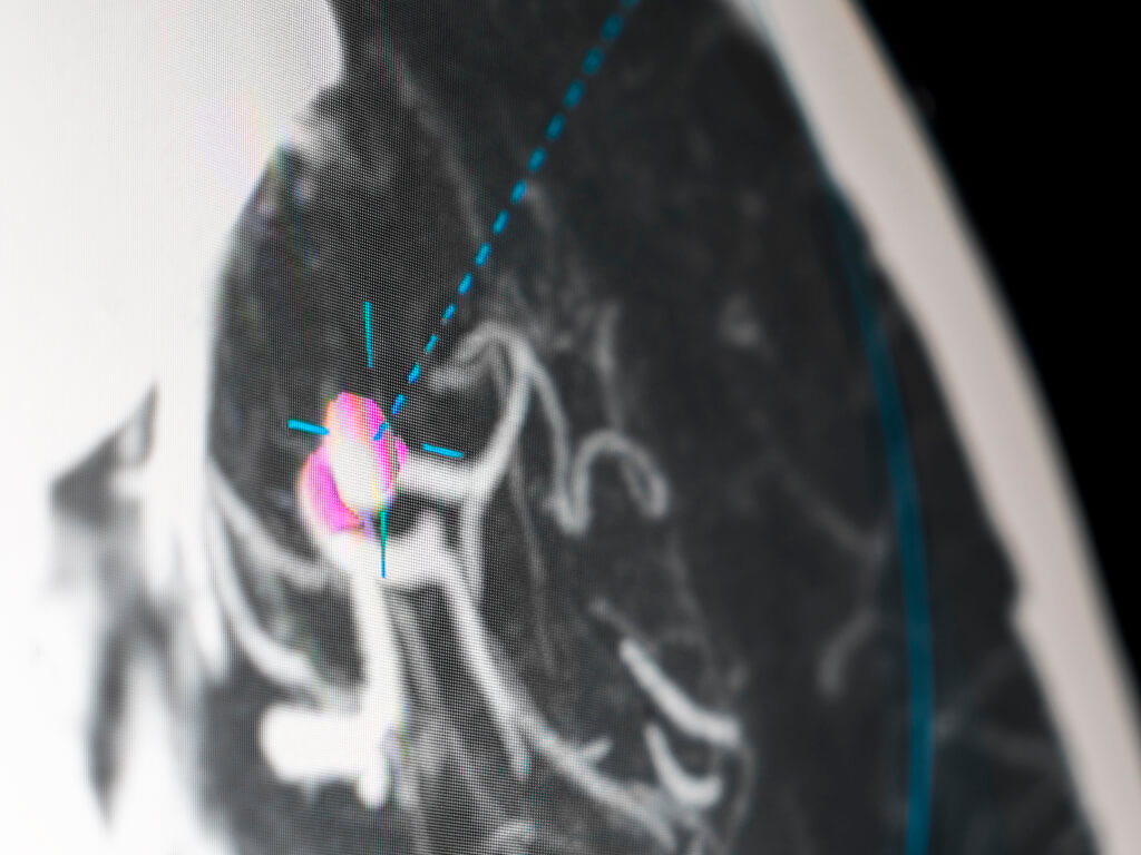 Neuro microscope software allows the surgeon to gain additional insights during cranial surgery