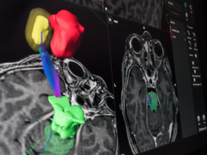 Surgical planning software helps surgeons assess structures at risk, plan trajectories and fuse images to aid in decision-making