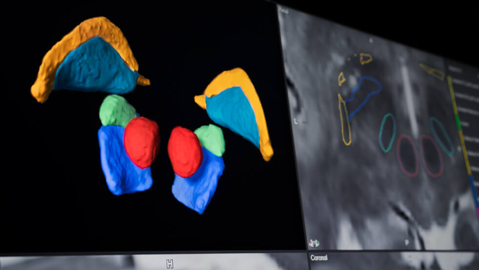 Le logiciel Elements Segmentation permet de contourer des structures anatomiques de la zone des noyaux gris centraux pour la planification de la chirurgie stéréotaxique du cerveau