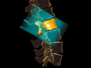 Elements Spine SRS Stereotactic Radiosurgery
