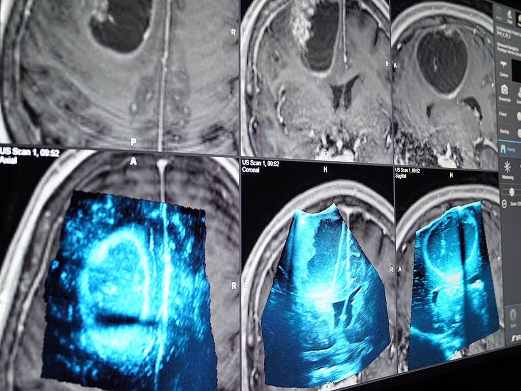 Facilidade de comparação de imagens intraoperatórias de ultrassom 3D com imagens pré-operatórias nas reconstruções axial, coronal e sagital