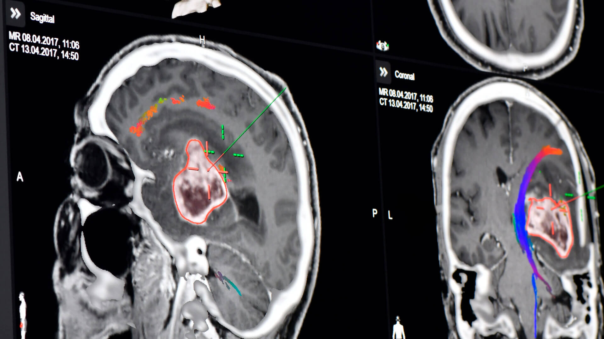 Überlagerung der fusionierten CT-Datensätze zeigt anatomische Details der verschiedenen Modalitäten in einer Ansicht