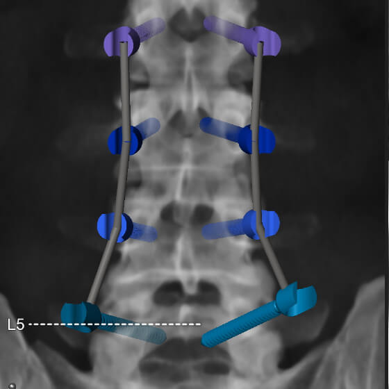 Программное обеспечение для планирования размещения винтов при спинальных процедурах Spine Screw Planning от Brainlab Elements