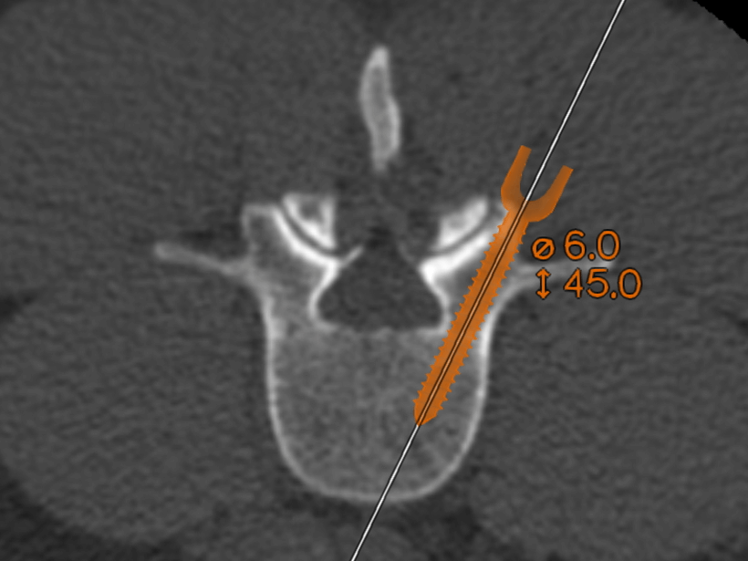Logiciel de chirurgie du rachis guidée par l’image possible avec les images acquises en 3D et les séries de données IRM ou TDM