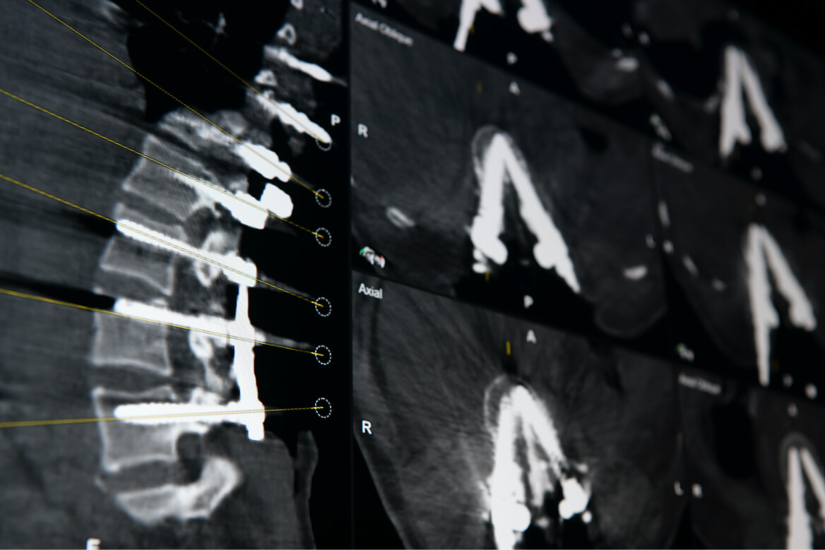 在轴位和矢状视图中对整个脊柱进行 CT 扫描