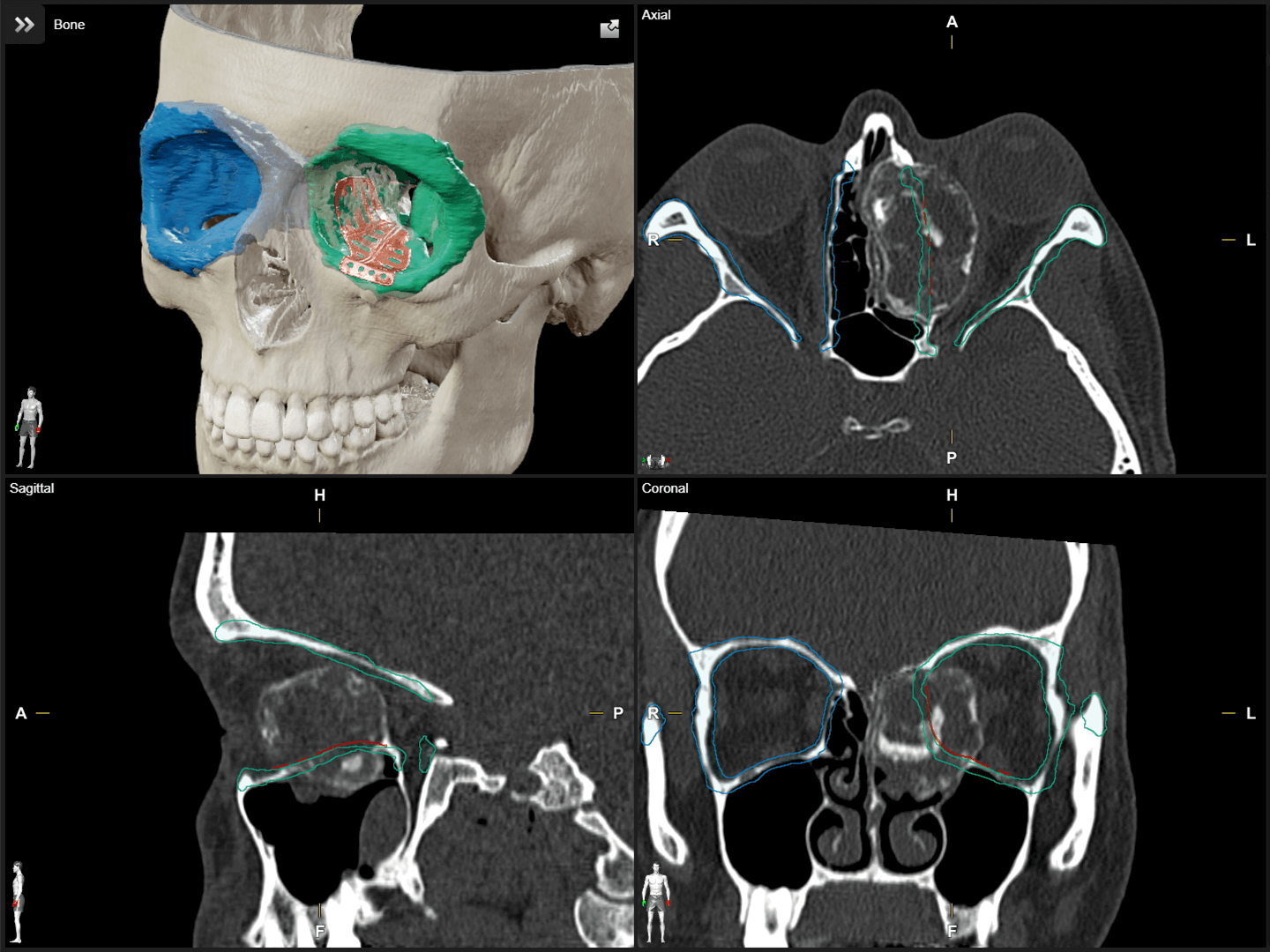 Four views of imaging scans of a skull with segmented objects used for craniomaxillofacial surgery planning