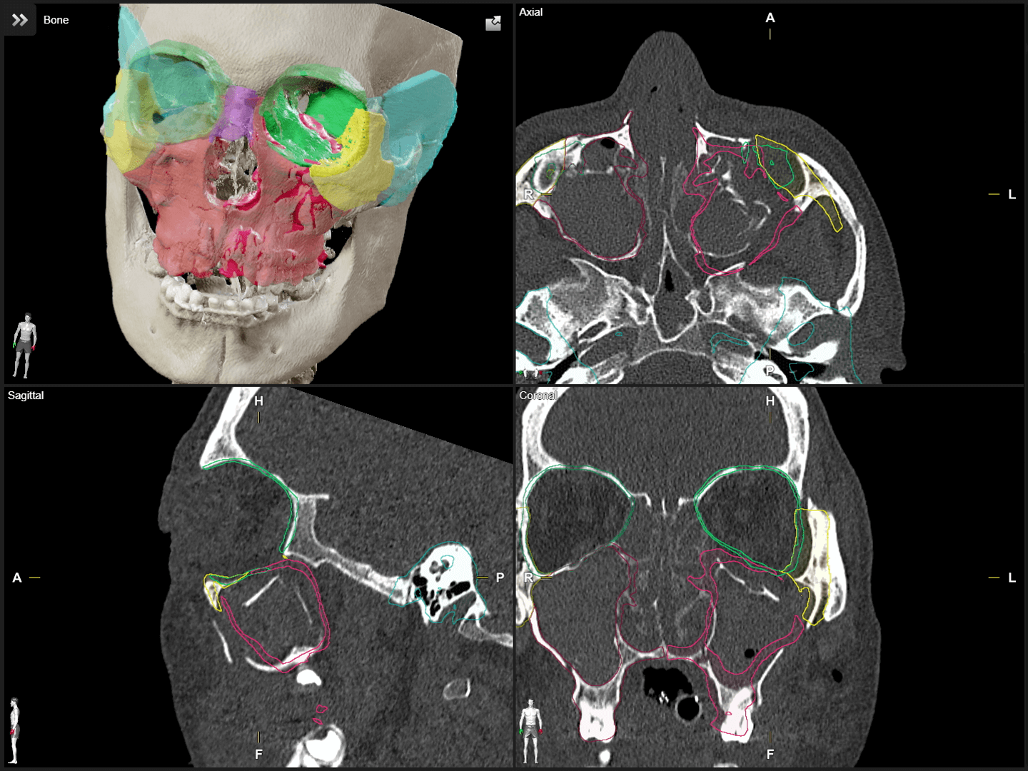 Screenshot einer Rasteransicht mit vier Ansichten eines Schädels. Verschiedene Knochenregionen sind in unterschiedlichen Farben zur Planung eines MKG-Eingriffs hervorgehoben.