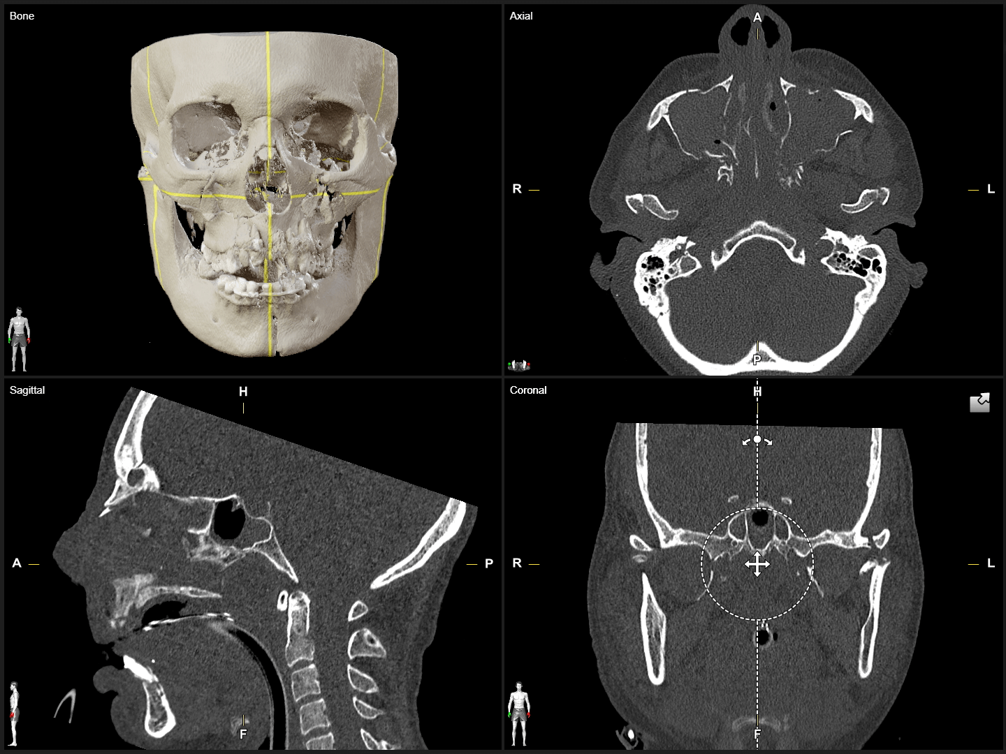 A grid of four different views of scans and 3D renderings in Elements Viewer software of a skull used to plan craniomaxillofacial surgeries.