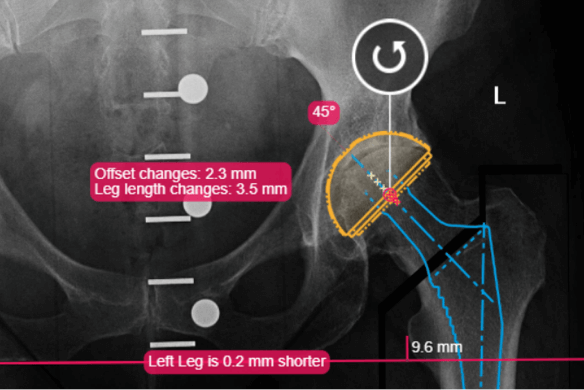 Intelligent measuring and templating tools help surgeons to quickly plan even complex procedures for deformity correction, pediatric, trauma, spine, upper limb, foot & ankle procedures