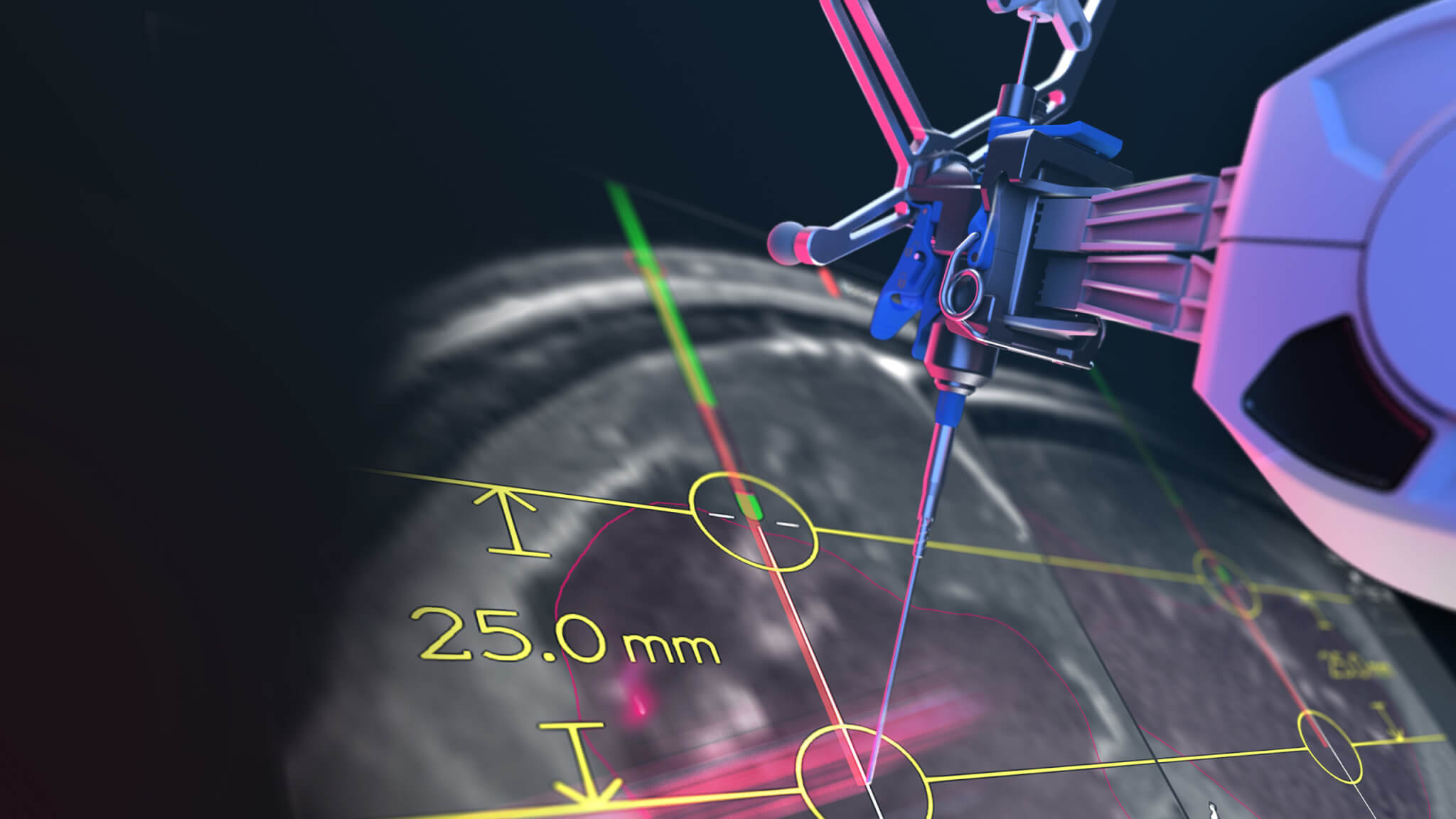 Um braço robótico Cirq para cirurgia de crânio aponta seu módulo para uma representação renderizada em uma tela de software de navegação cirúrgica