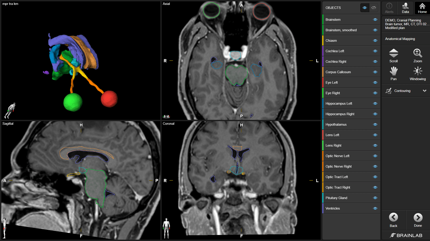 Capture d’écran du logiciel Anatomical Mapping utilisé pour segmenter différentes structures du cerveau pour la planification du traitement de radiothérapie.